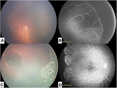 Aggressive Posterior Retinopathy of Prematurity: Long-Term Outcomes Following Intravitreal Bevacizumab